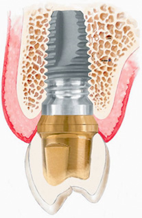 Dental Implants: Rise In Popularity